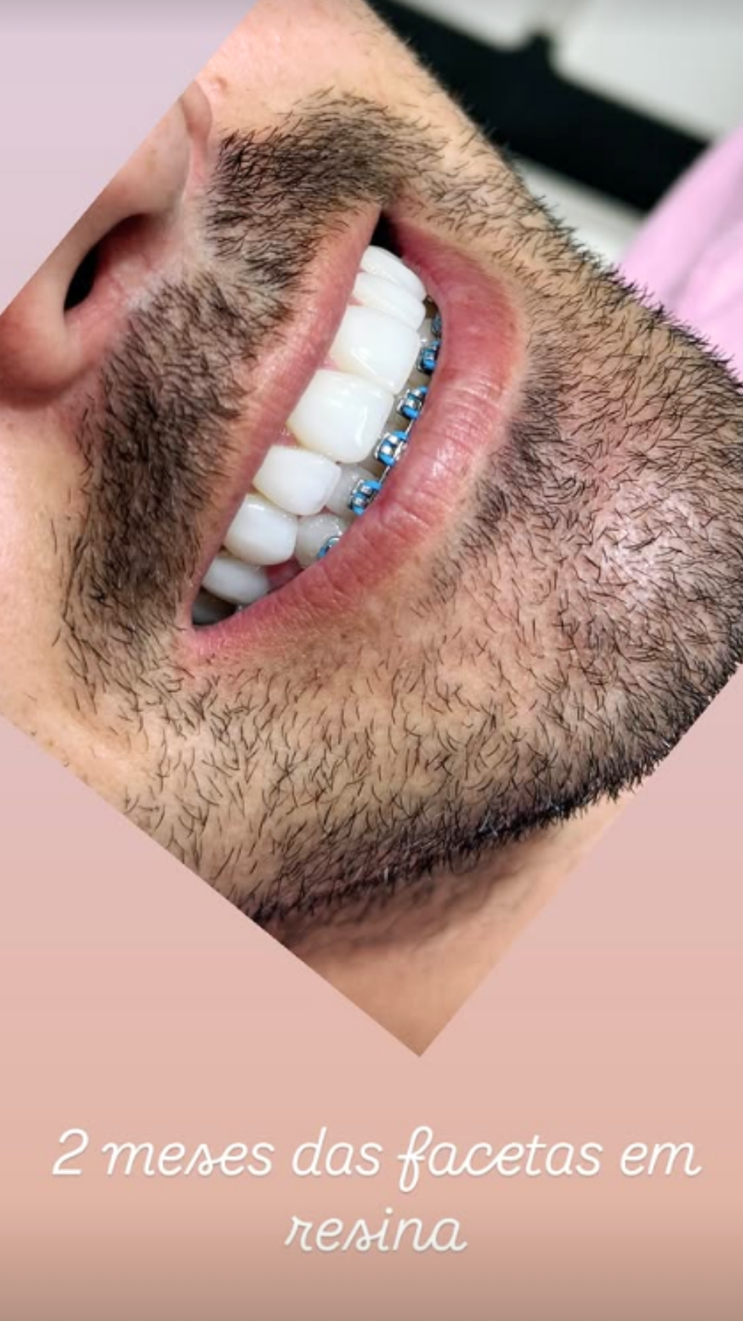 Faceta em Resina — AR Odontologia