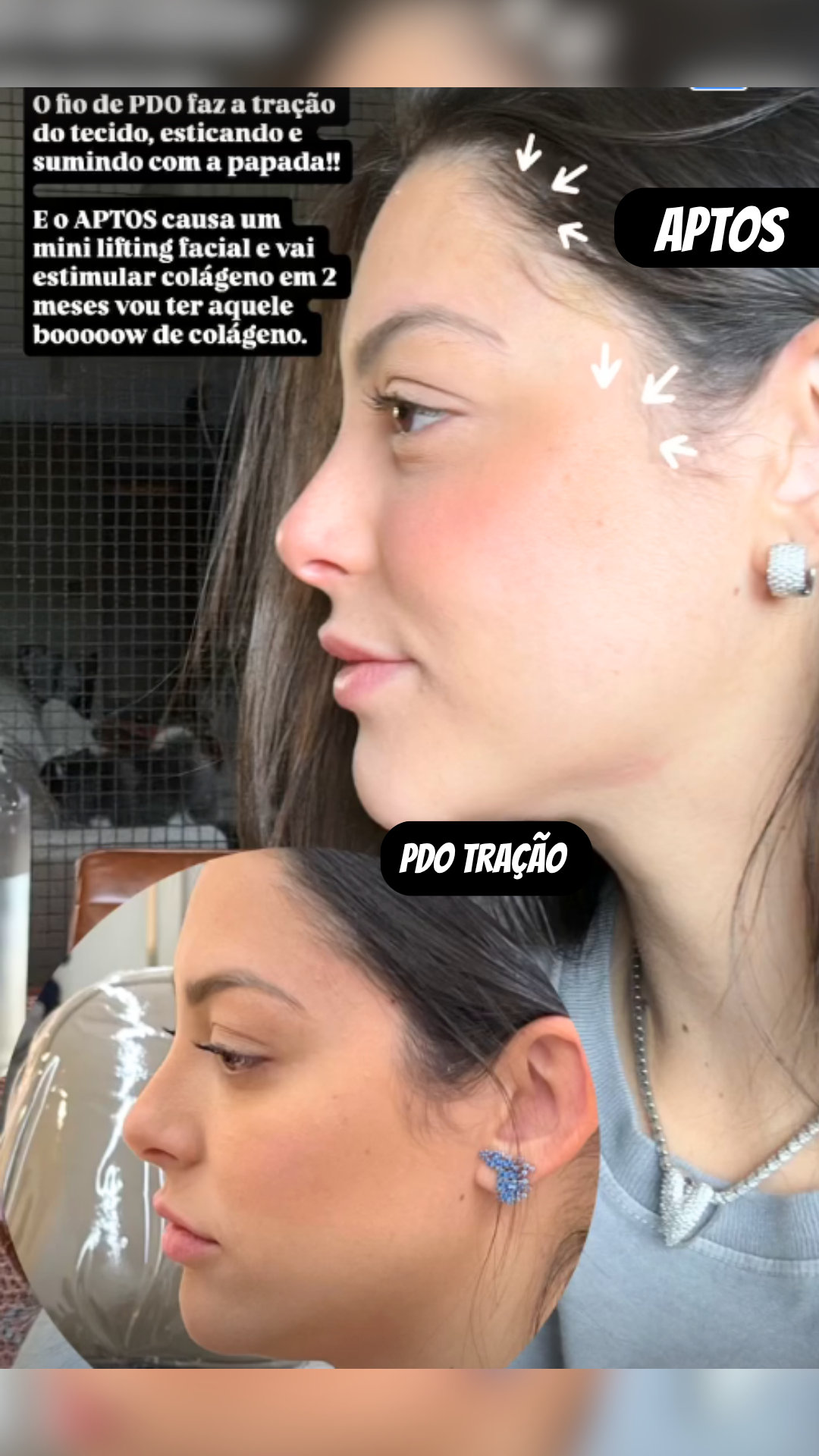 Fio APTOS — AR Odontologia