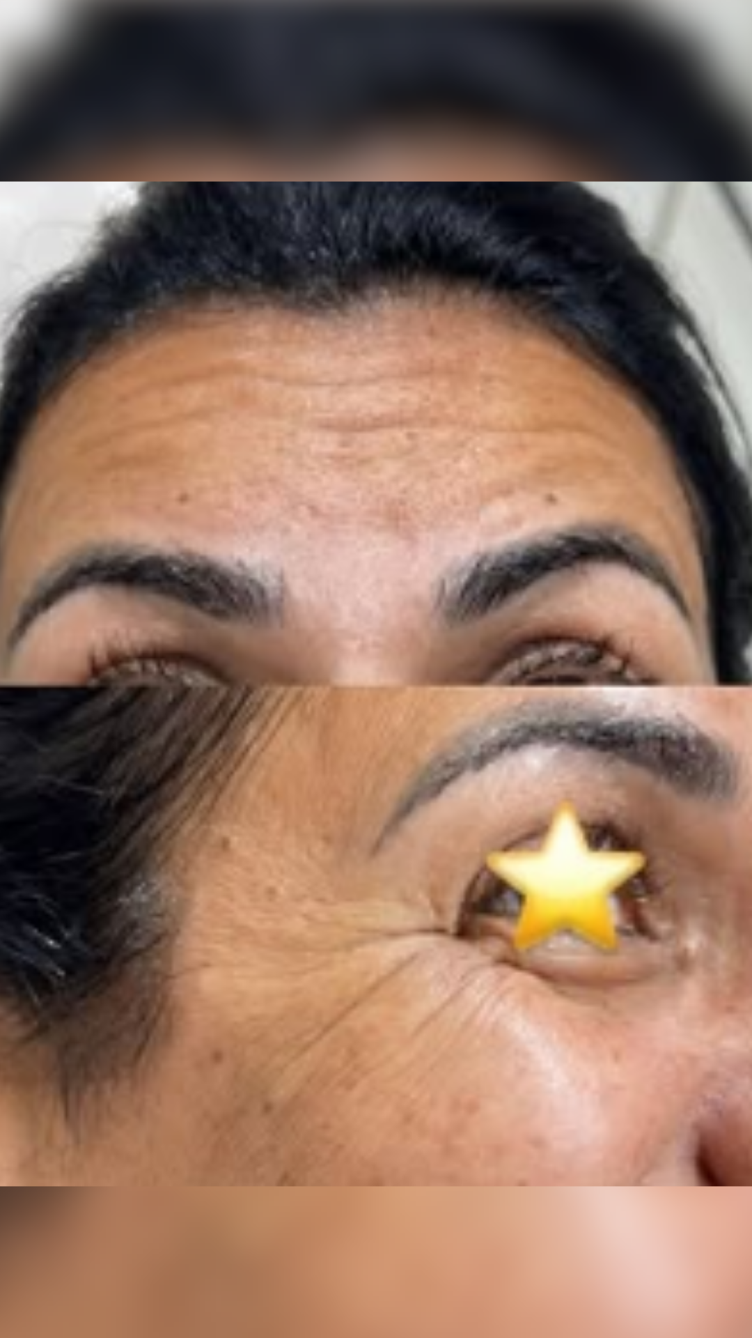 Antes — Harmonização Facial