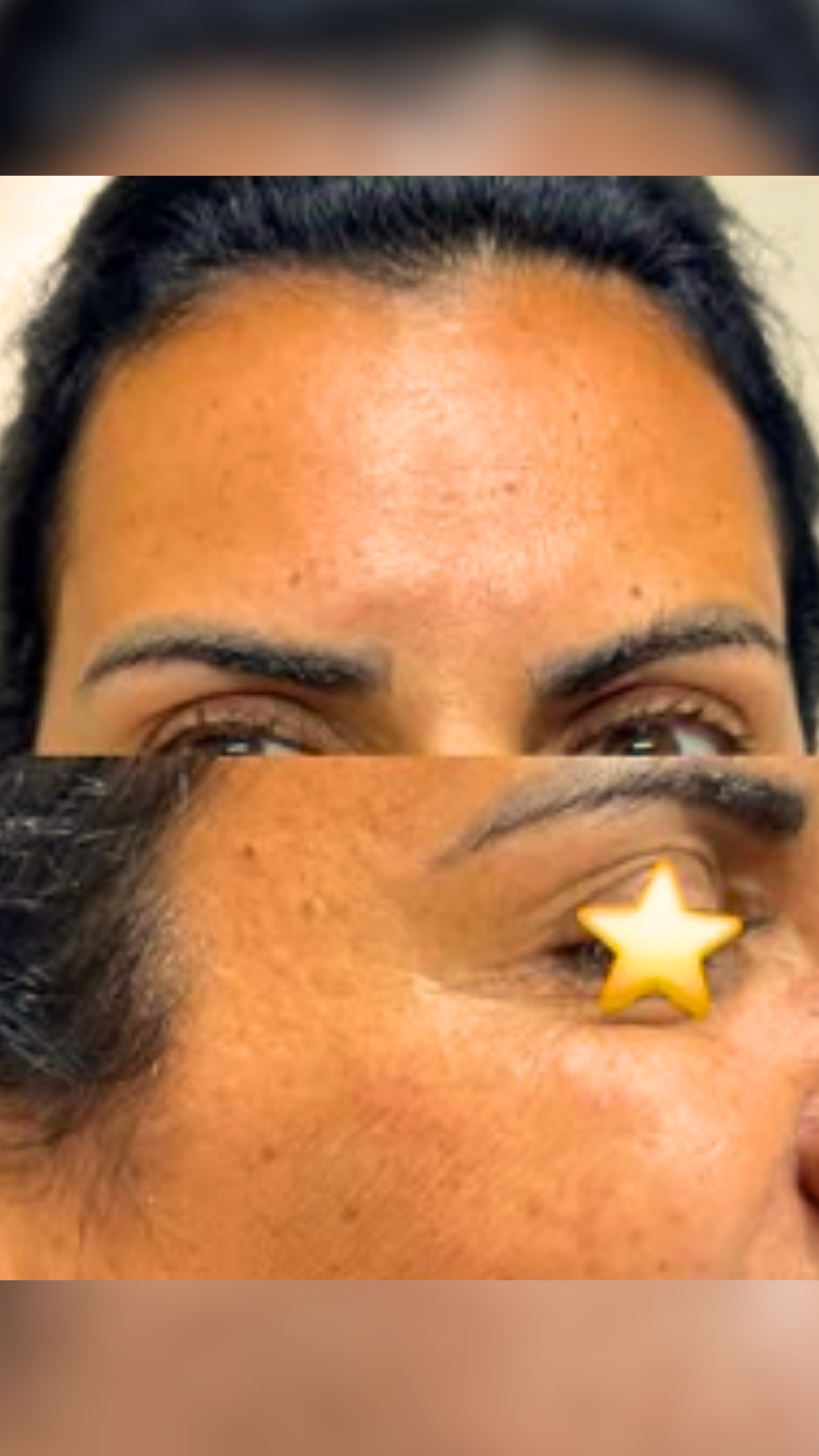 Depois — Harmonização Facial
